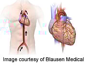 Aspirin, Warfarin Fare Equally for Heart Failure Patients