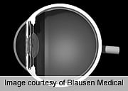 Statin Use Tied to Possible Boost in Cataract Risk