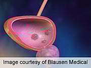 IBCG Proposes New Definition in Bladder Cancer