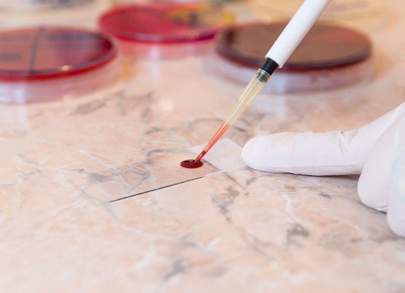 Blood Test Could Speed Diagnosis of Bipolar Disorder MedNews