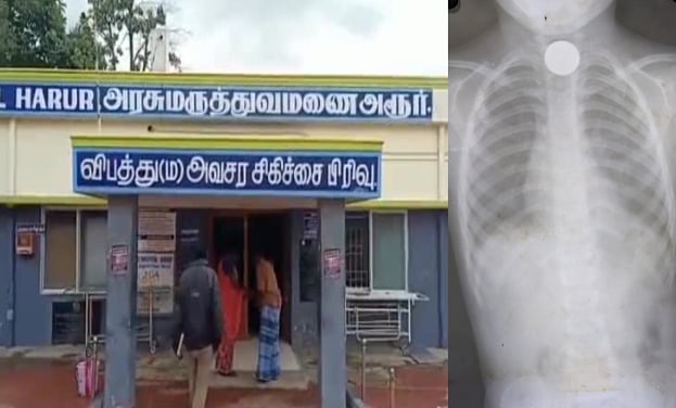 5 ரூபாய் நாணயத்தை விழுங்கி உயிருக்கு போராடிய சிறுவன்: தூரிதமாக செயல்பட்டு காப்பாற்றிய அரசு மருத்துவர்கள்!