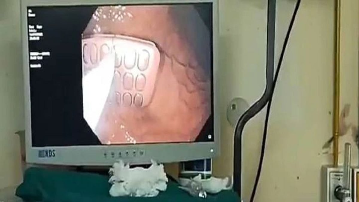 வயிற்று வலியால் துடித்த கைதி; அதிர்ந்து போன மருத்துவர்கள் - திகாரில் பரபரப்பு; நடந்தது என்ன?