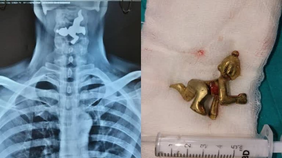 “கடவுள் பக்தியில் புனித நீரோடு சிலையை விழுங்கிய பக்தர்?” :  தொண்டையில் சிக்கிய சிலையால் நடந்த விபரீதம்!