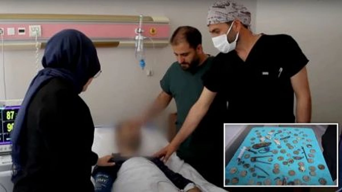 இளைஞர் வயிற்றில் இருந்த 233 நாணயங்கள், கற்கள்.. மருத்துவர்கள் அதிர்ச்சி: நடந்தது என்ன?