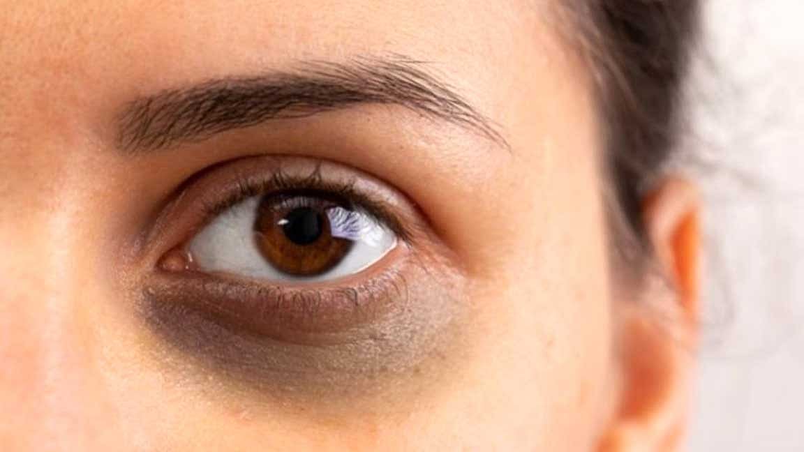 கண் கருவளையம் நீங்க எளிய குறிப்புகள்!