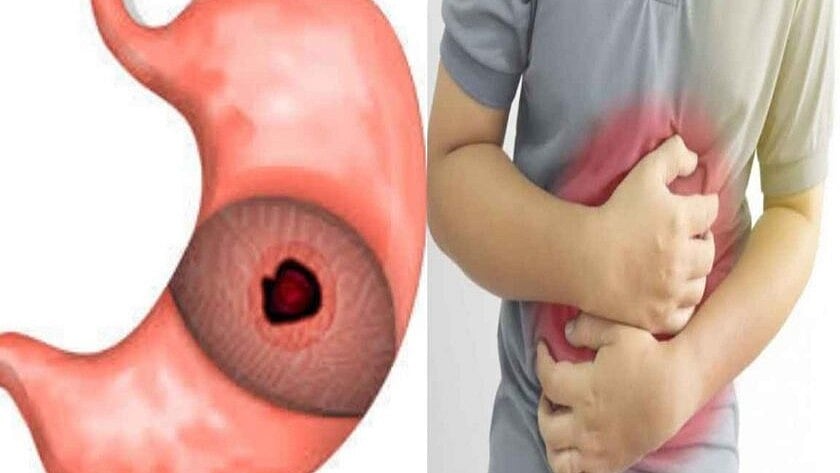 குடல் புண் உள்ளவர்கள் சாப்பிட வேண்டிய உணவுகள்!