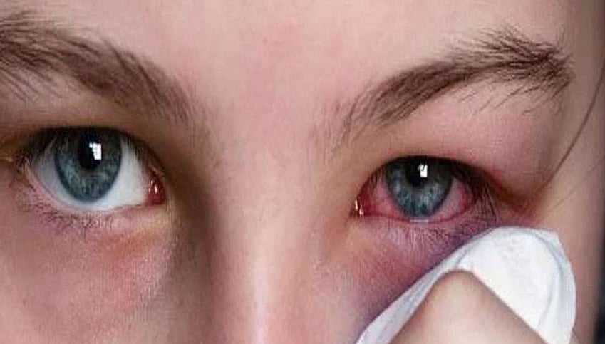 தமிழ்நாட்டில் அதிகரிக்கும் மெட்ராஸ் ஐ: அறிகுறிகளும், சிகிச்சையும்!