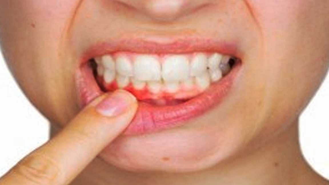 பற்களின் மஞ்சள் கறை நீங்க வீட்டு வைத்தியம்!