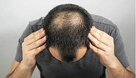 இளவயது தலை வழுக்கைக்குக் காரணம் என்ன தெரியுமா?