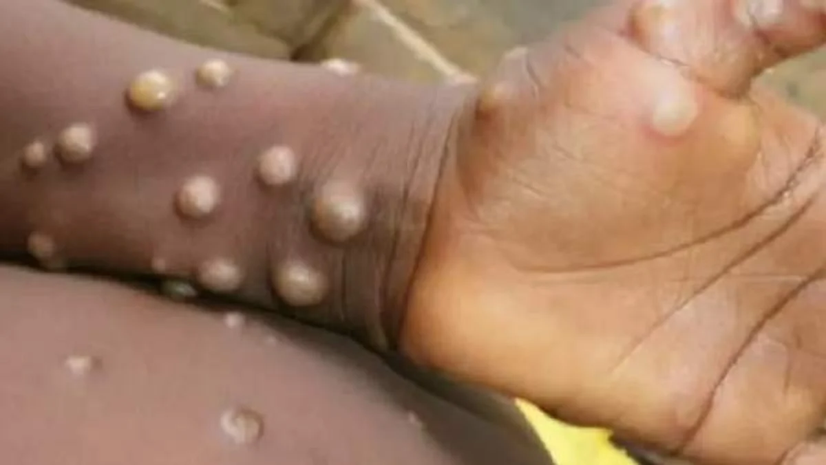ஆந்திராவிலும் தலைகாட்டியது குரங்கு அம்மை: சவுதியில் இருந்து வந்த குழந்தைக்கு அறிகுறி!