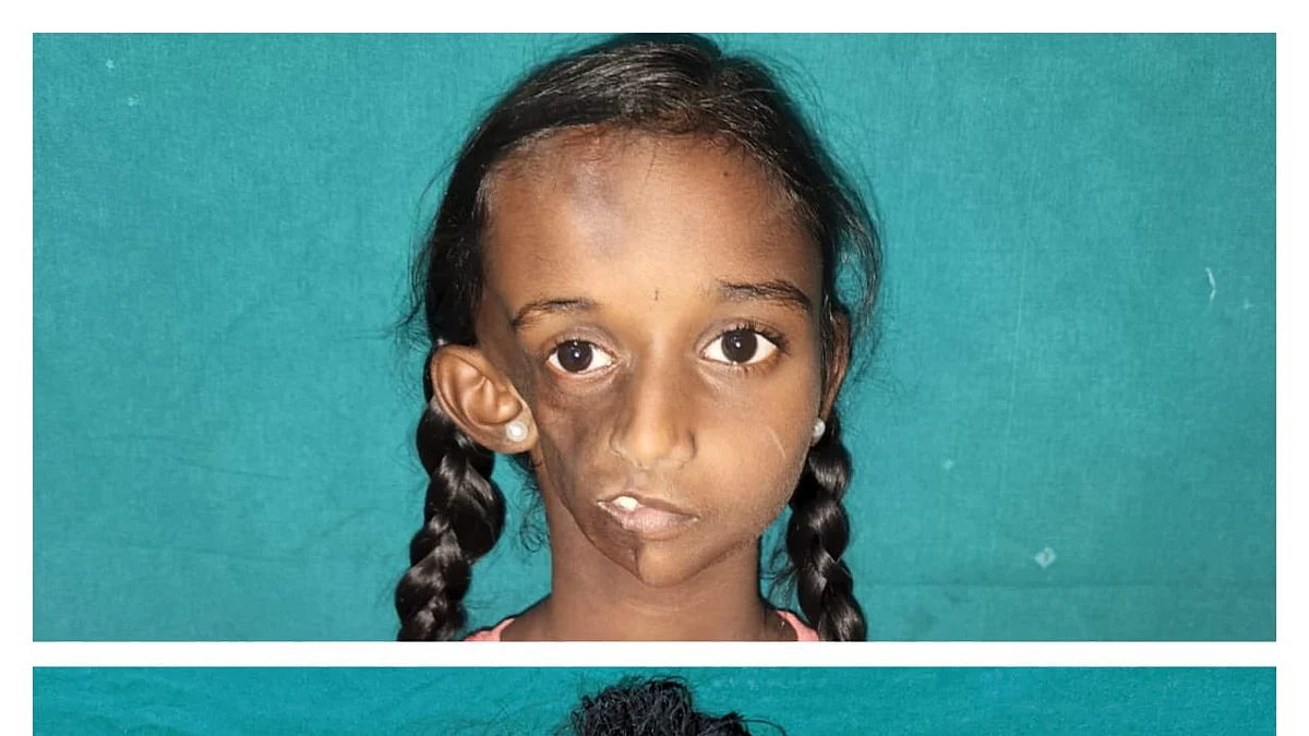 ஆவடி சிறுமி தான்யா எப்படி இருக்கிறார்?- புகைப்படத்தை வெளியிட்டது மருத்துவமனை