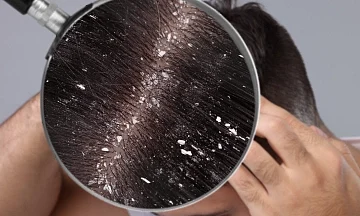 dandruff