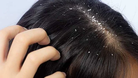natural dandruff solutions