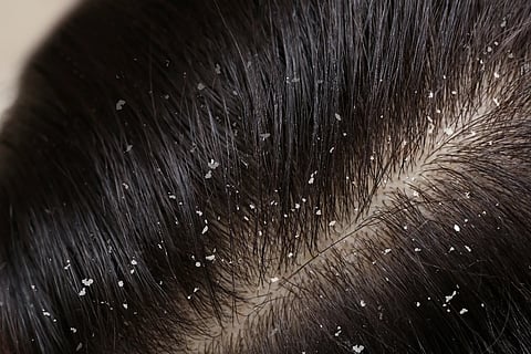 dandruff solution