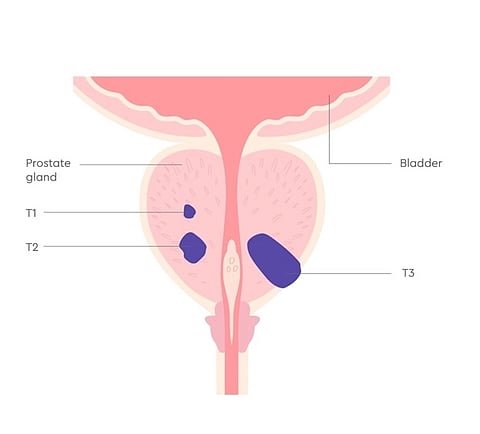 prostate cancer