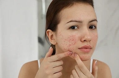 how to prevent acne 