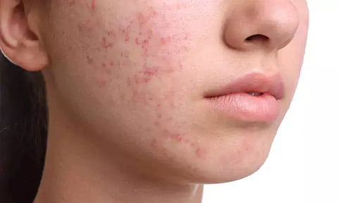 வெறும் வயிற்றில் இந்த ஒரு பானம் குடித்தால்.. முகப் பருக்கள் குறையுமா?