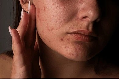 இனி முகத்தில் ஒரு தழும்பு கூட இருக்காது! பருக்களை வேரோடு அழித்து.. கண்ணாடி போல ஜொலிக்கும் முகம் பெற இந்த வைத்தியம் போதும்!