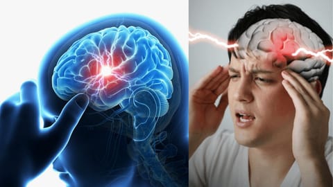 Brain Stem Stroke