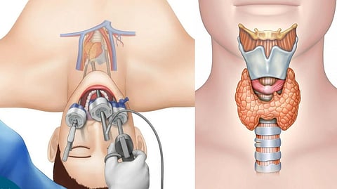 Scarless Thyroid Surgery