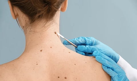 skin-cancer-signs