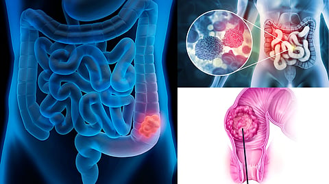 Rectal Cancer