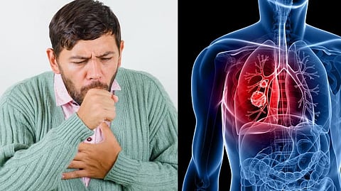 Non-smoker lung cancer