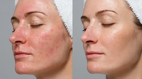 Facial Skin Irritation
