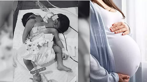 dicephalic-parapagus-baby-dies-after-seven-days