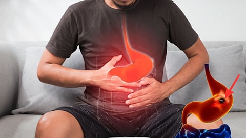 Stomach ulcer