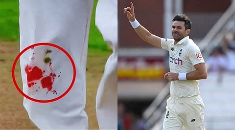 இந்தியாவுக்கு எதிராக ரத்தம் சொட்ட சொட்ட பந்துவீசிய ஜேம்ஸ் ஆண்டர்சன்...