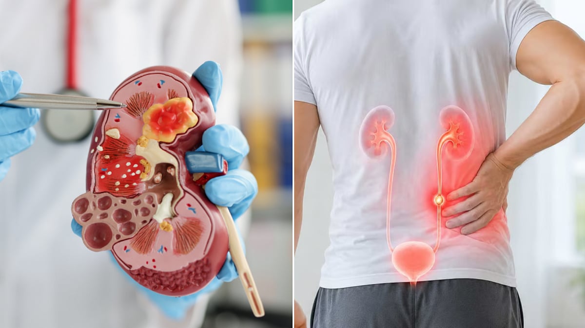 Does the pain from a kidney stone suddenly disappear? It is dangerous ...