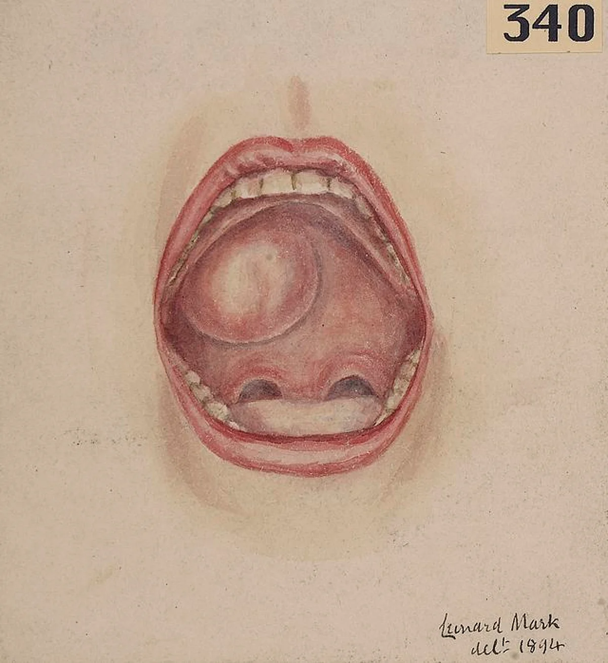 There has been a steady increase in the toll of oral cancer cases globally, in the past decade and 99 percent of these cases can be prevented if diagnosed early (representational image - Wikimedia)