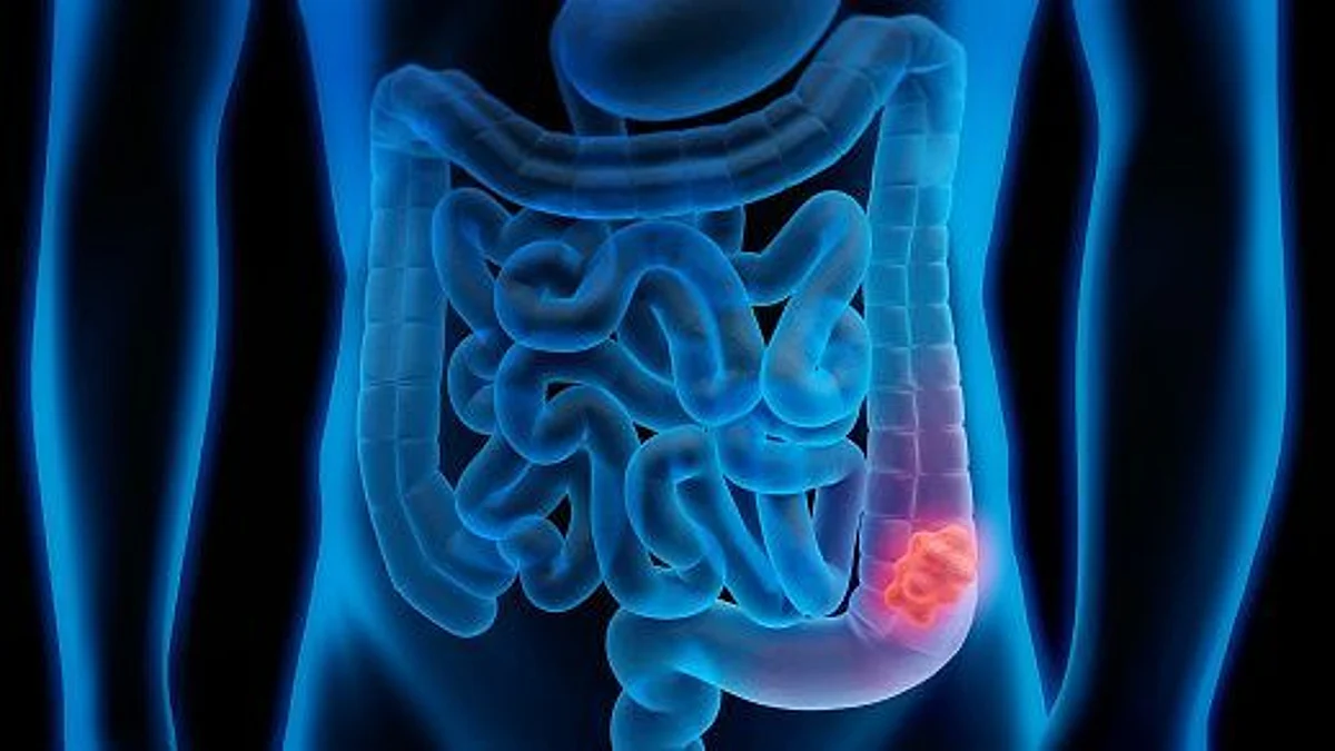 New study on Colorectal Cancer (representational image - Unsplash)