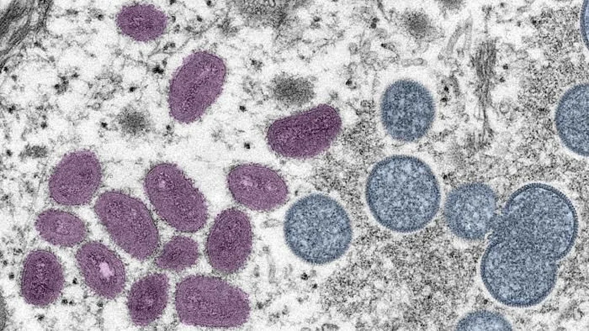 Monkeypox linked to acute heart problem in 1st case study (CDC PHIL)