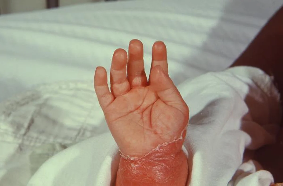 Telangana baby with rare genetic disease given Rs 16 crore drug (representational image - CDC PHIL)