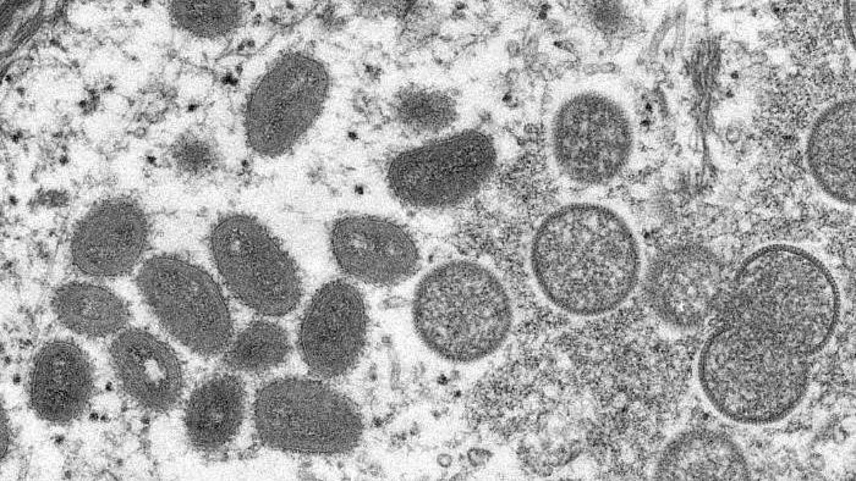 Differences in monkeypox symptoms: current and previous outbreaks (representational image - CDC PHIL)