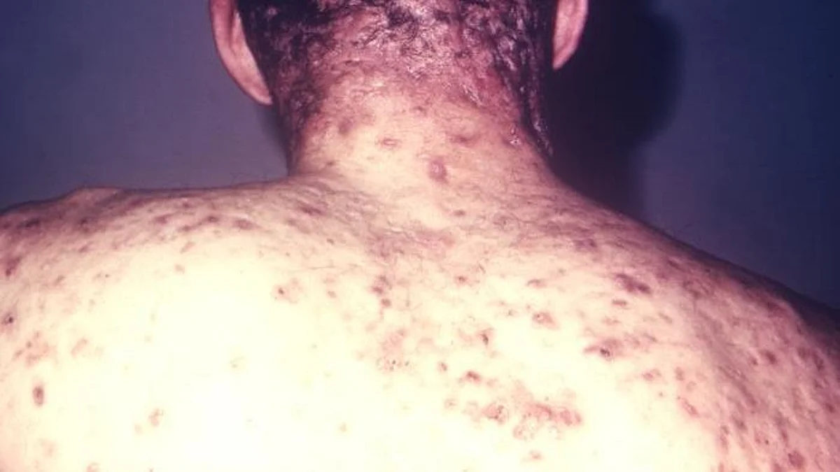 All about body acne and how to tackle it? (CDC PHIL)