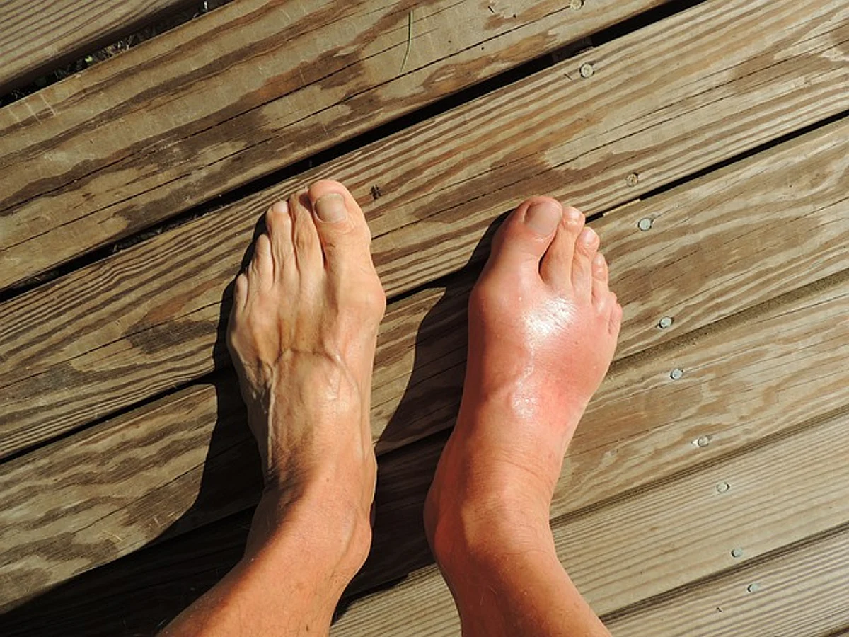 Flare-ups of gout are linked to heart attack and stroke - Study (representational image - Pixabay)