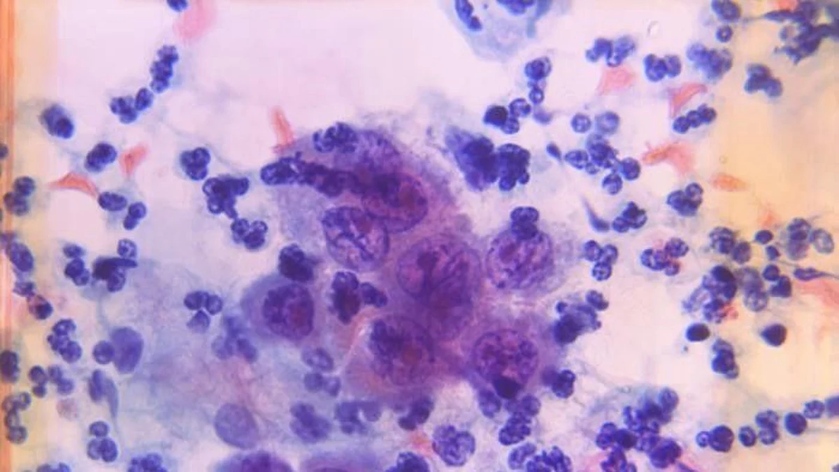 Cancer risk: Changes in diet, lifestyle, and during childhood (CDC PHIL)