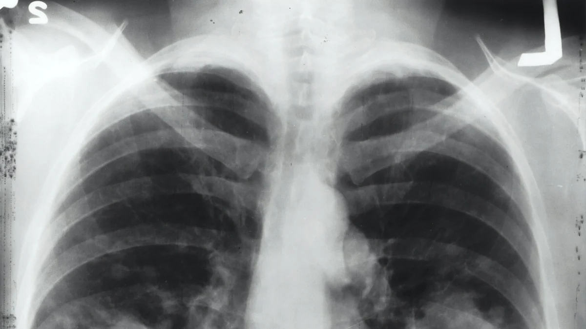 Sexual Dysfunction High Among Women with Lung Cancer (representational image - Unsplash)