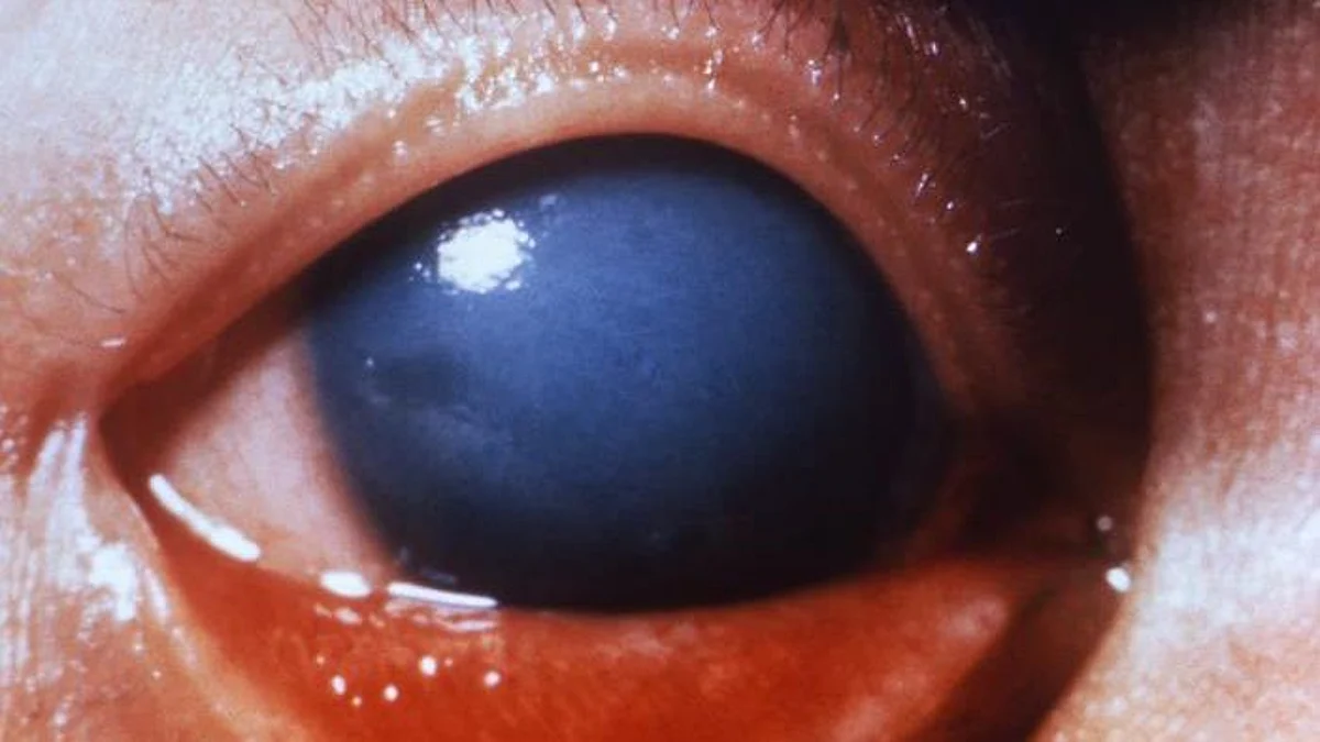 A new, non-invasive ocular imaging method may be able to detect an early indicator of glaucoma in time to prevent disease progression and vision loss, according to a new study from New York Eye and Ear Infirmary of Mount Sinai (representational image - CDC PHIL)