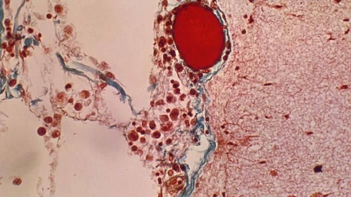 COVID-19 infection increases the risk of potentially life-threatening blood clots for at least 49 weeks, according to a new study of 48 million unvaccinated adults from the first wave of the pandemic (CDC)