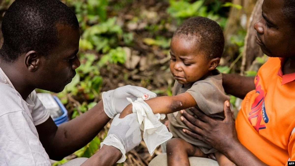 A child affected by monkeypox, sits on his father's legs while receiving treatment at the center of Doctors Without Borders, in Zomea Kaka, in the Lobaya region, in the Central African Republic, Oct. 18, 2018 (Image Source- Unsplash)