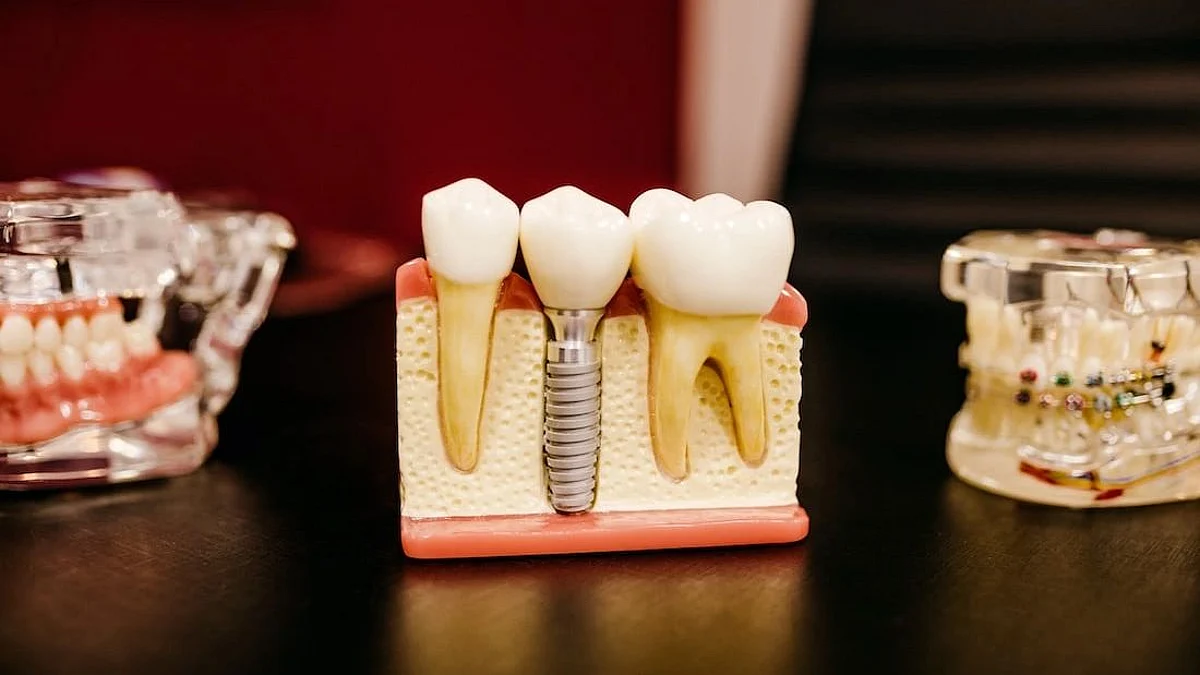Dental implants
