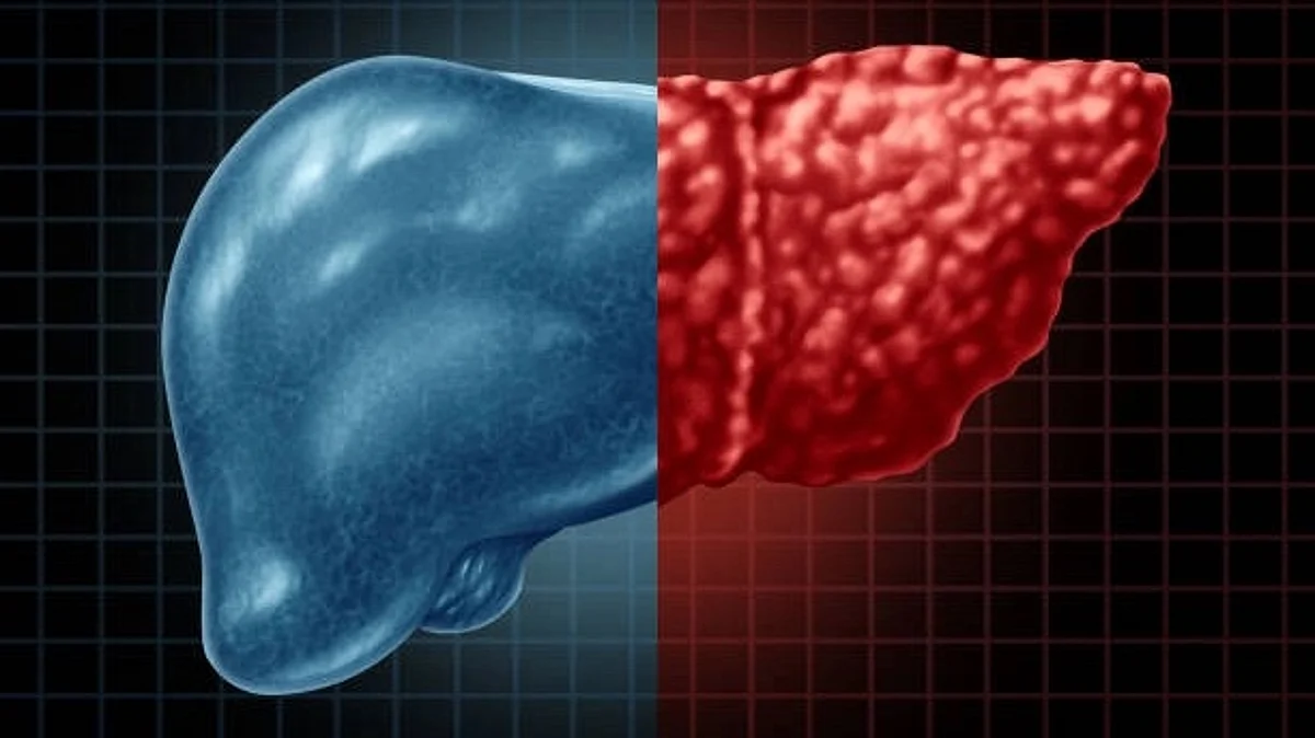 Genetic mutations that contribute to nonalcoholic fatty liver disease (NAFLD), providing a potential future target for therapeutic interventions (Unsplash)
