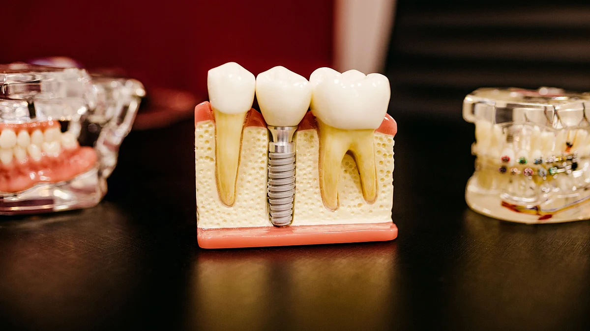 Scientists have perfected hydroxyapatite, a material for mineralizing bones and teeth. By adding a complex of amino acids to hydroxyapatite, they were able to form a dental coating that replicates the composition and microstructure of natural enamel.(Unsplash)