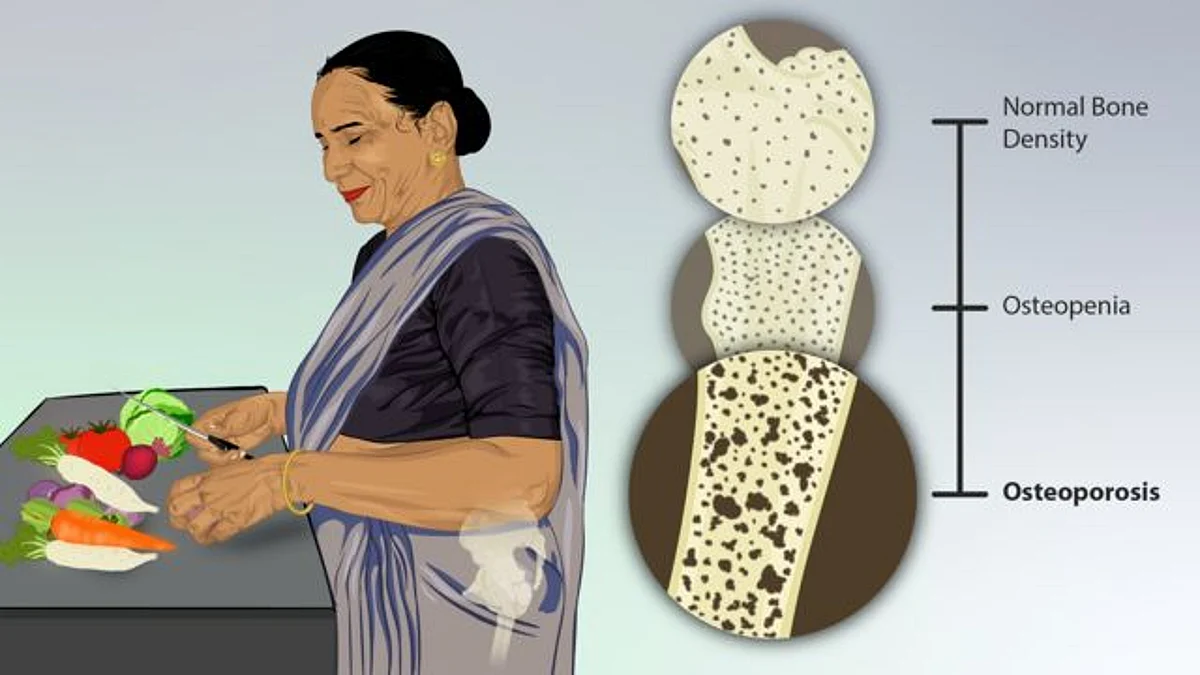 Osteoporosis is a common bone disease that occurs due to a decrease in the density of bone, decreasing its strength and resulting in fragile bones that break or fracture easily.