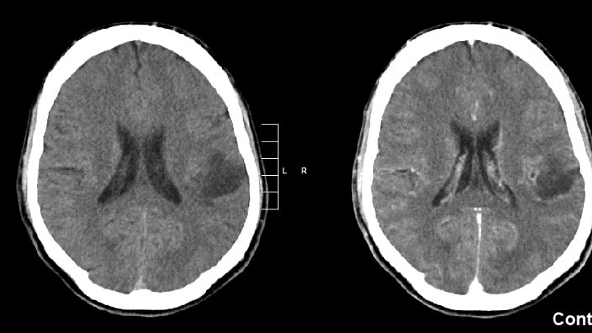 An important new clue for preventing and treating brain tumors known as gliomas has been identified in research led by the Lunenfeld-Tannenbaum Research Institute (LTRI) at Mount Sinai Hospital in Toronto and Mayo Clinic Comprehensive Cancer Center and Mayo Clinic Center for Individualized Medicine. The study, published in the journal Science, provides a rare window into the biological changes behind glioma development (Wikimedia Commons)