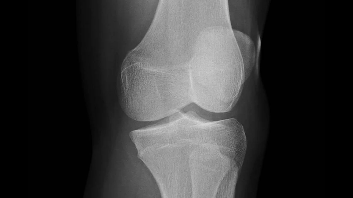 Cementless knee replacement, an alternative approach to the traditional surgery in which bone cement is used, is gaining interest among orthopedic surgeons.(unsplash)
